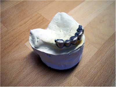 Picture Of Dental Mold In Progress